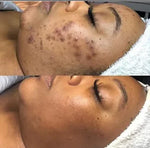 Charger l&#39;image dans la galerie, Gel d&#39;Aloe Vera Anti-Acné
